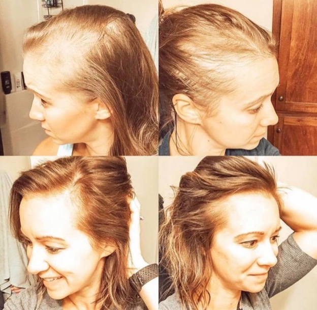 4 image collage of a woman's before and after hair growth. First two images there is a lot of hair loss, the second two images show her hair grown in.