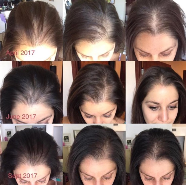 9 image collage of a woman's hair growth progress from April 2017 to June 2017 to September 2017.