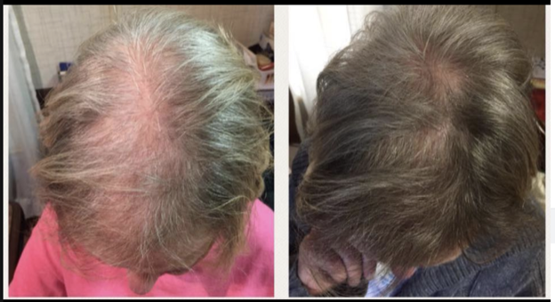 A before and after shot of the top of a woman's head showing her hair regrowth.