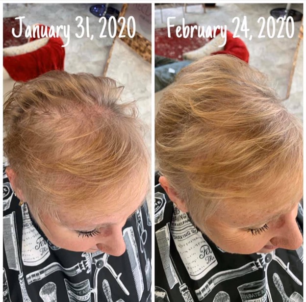 A before and after shot of a woman's hair regrowth from January 31, 2020 to February 24, 2020.