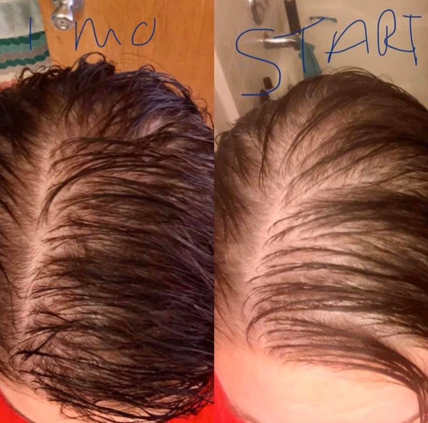 Before and after shot of the top of a woman's head and her hair regrowth.