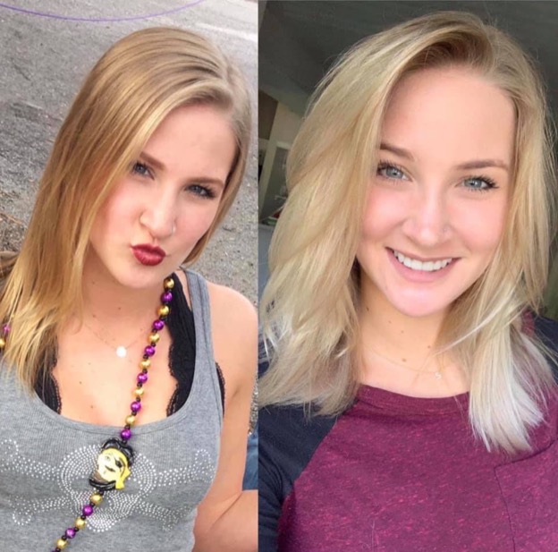 Two images of a woman's before and after hair regrowth. 