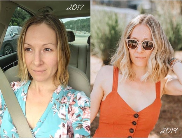 Two pictures, a before and after of a woman's hair regrowth.