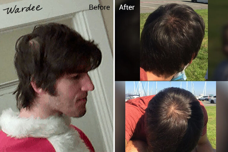 Head Massage for Hair Growth (+types and causes of hair loss)