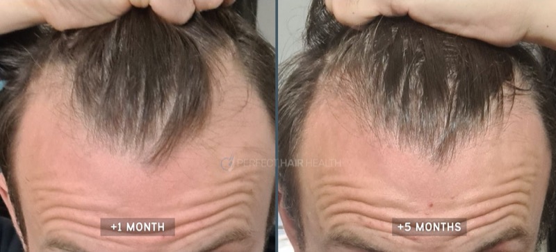 Before and after photos demonstrating a man's hair loss, and how much hair grew back after he started doing head massage.