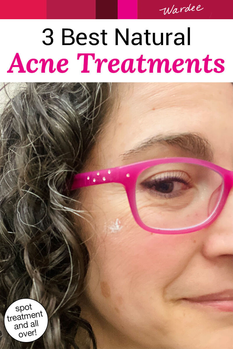 Close-up photo of a smiling woman wearing pink glasses with a spot on her cheek. Text overlay says: "3 Best Natural Acne Treatments (spot treatment and all over!)"