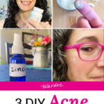 Photo collage of a smiling woman wearing pink glasses demonstrating various acne treatments, of white powder on a woman's fingertip, and a spray bottle labeled "zinc". Text overlay says: "3 DIY Acne Treatments (better than benzoyl peroxide or salicylic acid)"