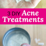 Photo collage of acne treatments: white powder and white cream on a woman's palm, and white powder on a woman's fingertip. Text overlay says: "3 DIY Acne Treatments (w/ anti-inflammatory & anti-bacterial zinc)"