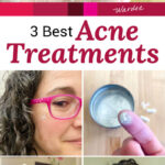 Photo collage of a smiling woman wearing pink glasses demonstrating various acne treatments, white powder and white cream on a woman's palm, white powder on a woman's fingertip, and a spray bottle labeled "zinc". Text overlay says: "3 Best Acne Treatments (w/ anti-inflammatory & anti-bacterial zinc)"
