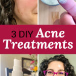 Photo collage of a smiling woman wearing pink glasses demonstrating various acne treatments, of white powder on a woman's fingertip, and a spray bottle labeled "zinc". Text overlay says: "3 DIY Acne Treatments (great for women over 40 & any age!)"