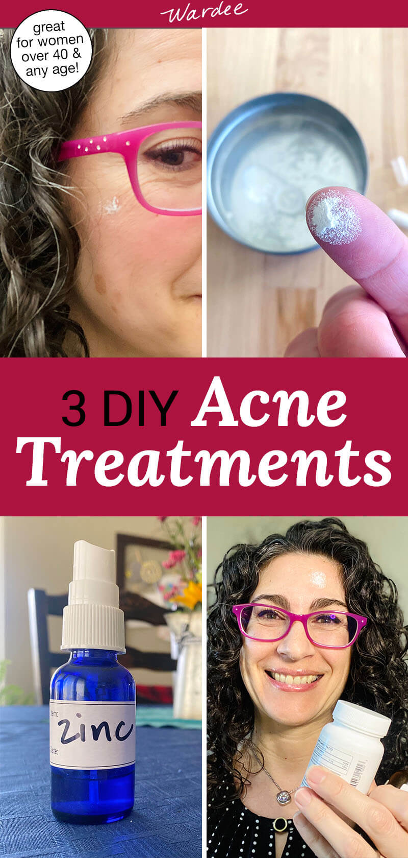 3 Best Natural Acne Treatments Spot Treatment and All Over!