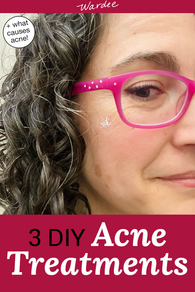 3 Best Natural Acne Treatments Spot Treatment and All Over!