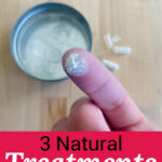 Close-up photo of white powder on a woman's fingertip. Text overlay says: "3 Natural Treatments for Acne (better than benzoyl peroxide or salicylic acid!)"
