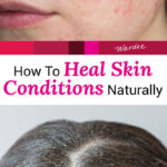 Photo collage of a woman with rosacea on her cheeks, and a woman with a flaky scalp. Text overlay says: "How to Heal Skin Conditions Naturally (eczema, psoriasis, rosacea, dandruff, KP, acne & more!)"