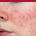 Close-up of rosacea on a woman's face and cheek. Text overlay says: "How to Heal Skin Conditions Naturally (detailed advice for each skin condition)"
