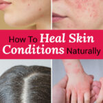 Photo collage of a variety of skin conditions, including acne, rosacea, a flaky scalp, and a child's hand and forearm covered in eczema. Text overlay says: "How to Heal Skin Conditions Naturally (why to avoid retinol skin care products)"