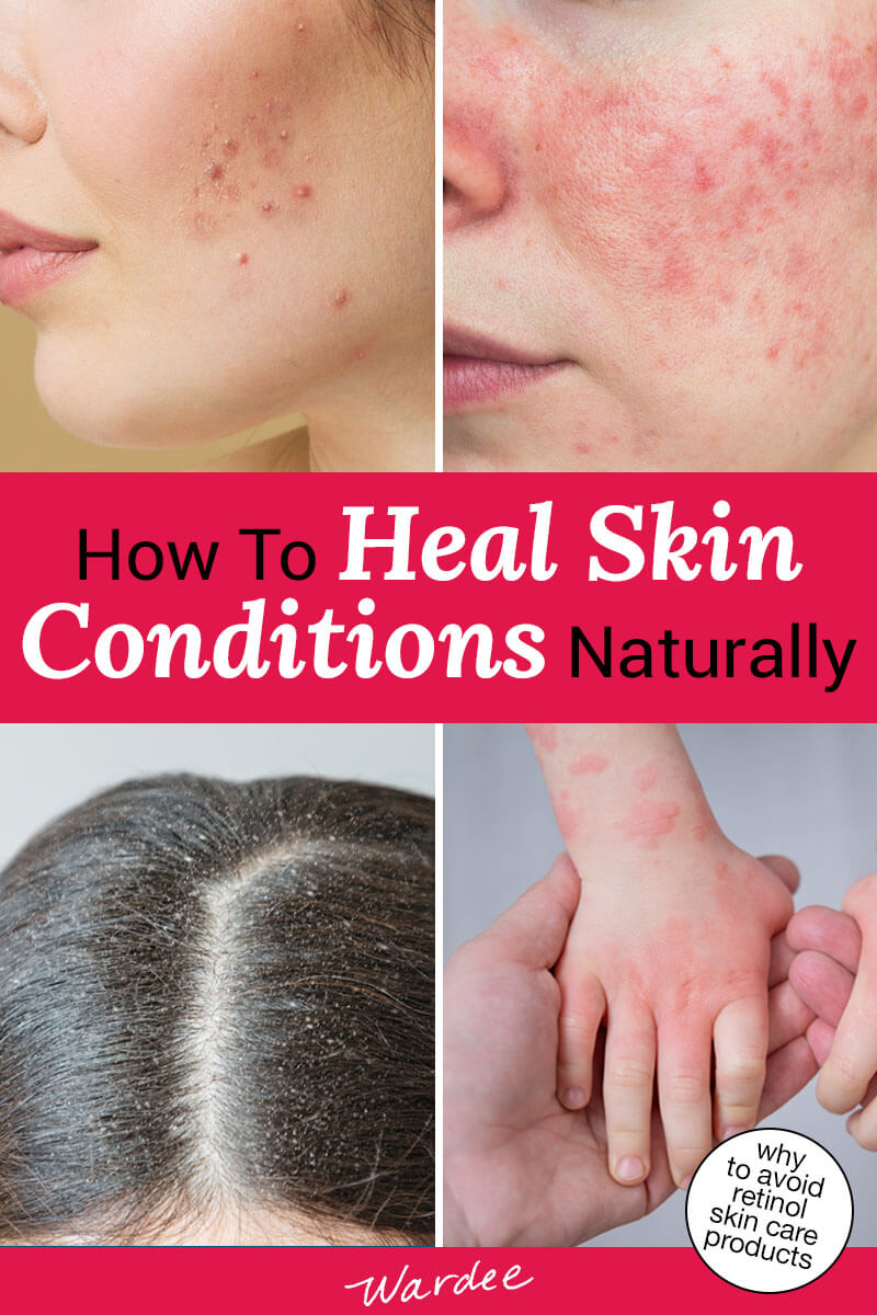 How to Heal Skin Conditions Naturally - Wardee