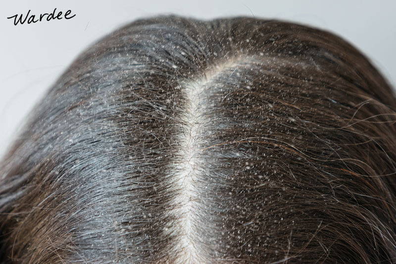 Close-up photo of a woman's flaky scalp.
