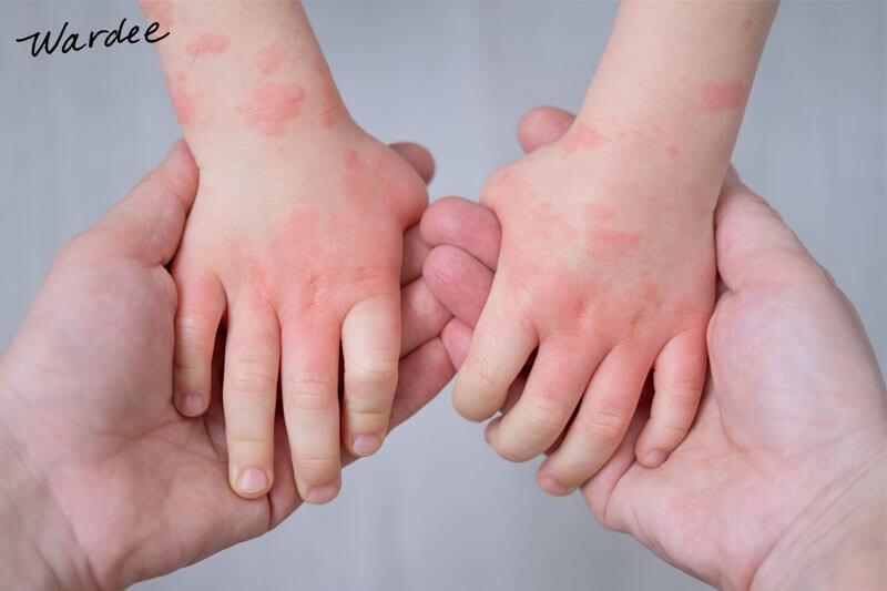A child's hands and forearms covered in a splotchy rash.