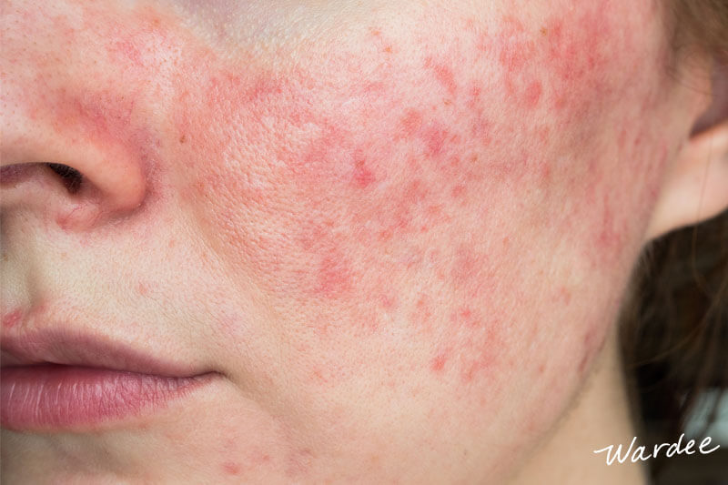 Close-up of rosacea on a woman's face and cheek..
