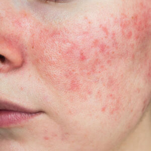 Close-up of rosacea on a woman's face and cheek..